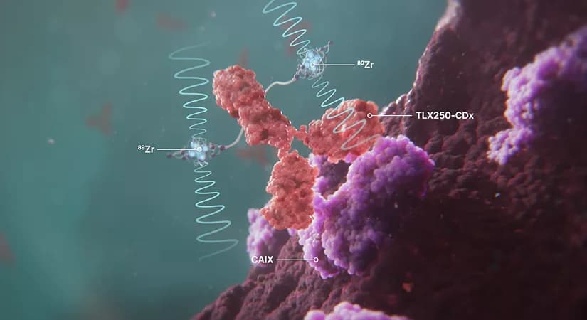 Telix Doses First Patient In Phase 3 LUTEON Trial For Kidney Cancer Therapy TLX250-Tx