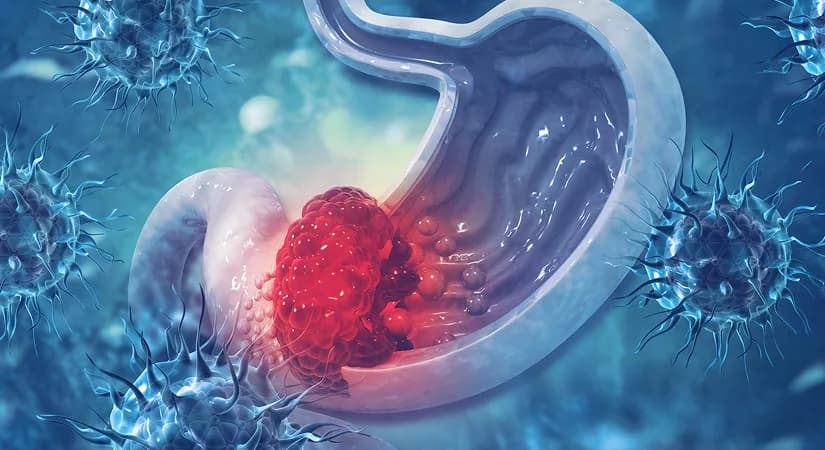 Sone-Ve Demonstrates Significant Overall Survival Benefit in Phase III Gastric Cancer Trial