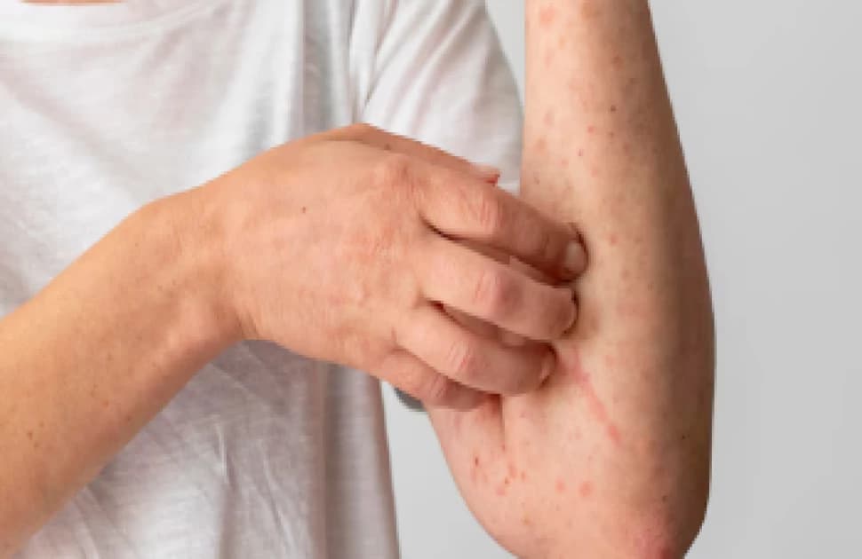 First death from measles reported in Ontario