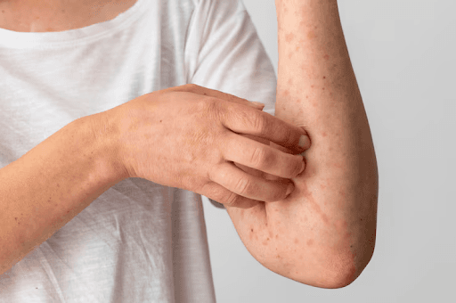 First death from measles reported in Ontario