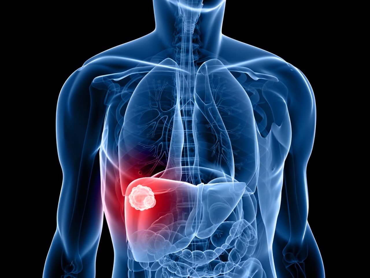 Tempest Secures FDA Approval to Move Forward With Pivotal Phase 3 Trial For Amezalpat In Liver Cancer