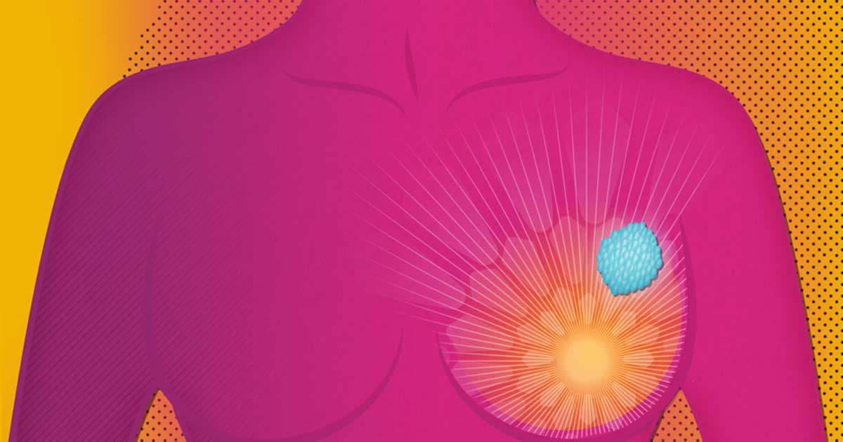 AstraZeneca and Daiichi Sankyo’s Datopotamab Deruxtecan Falls Short in Breast Cancer Survival Study