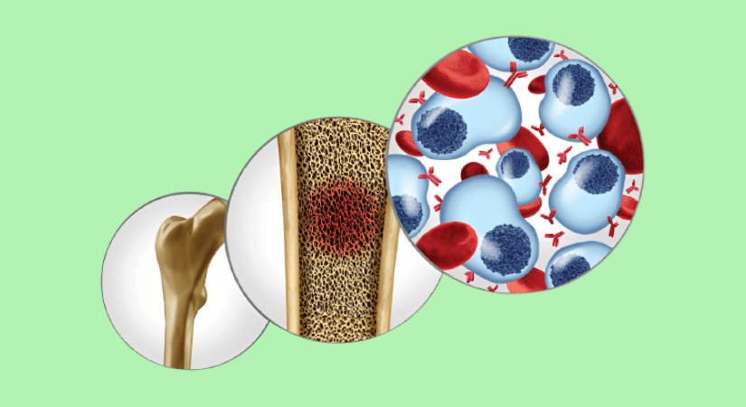 CARVYKTI® Outshines Standard Care In Achieving MRD Negativity For Relapsed Multiple Myeloma Patients
