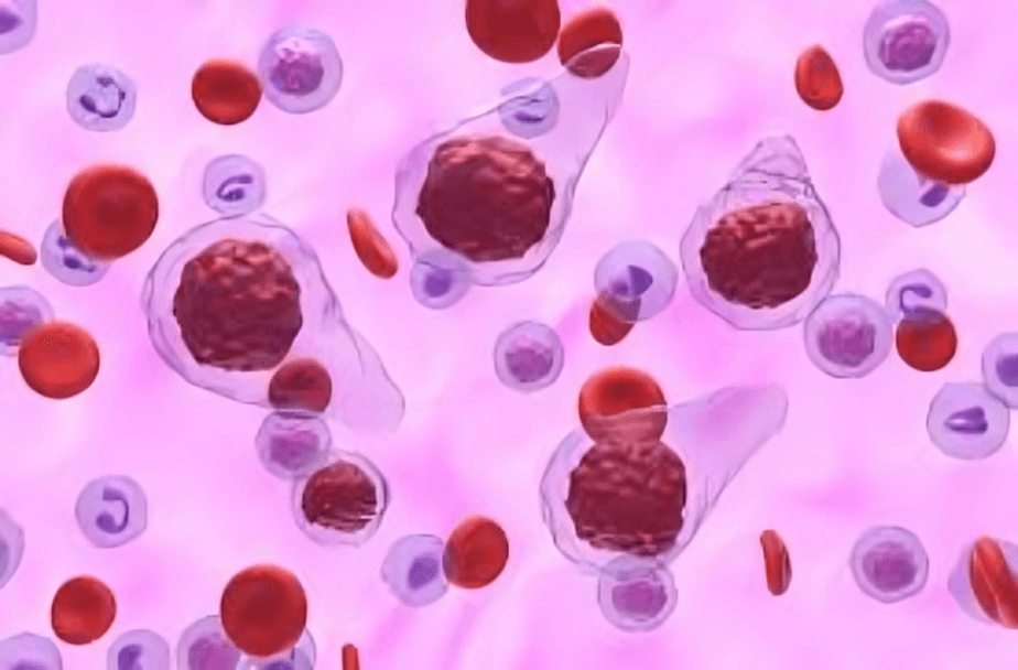 Gecacitinib Outperforms Hydroxyurea in Treating Myelofibrosis and Anemia: A New Hope for Patients