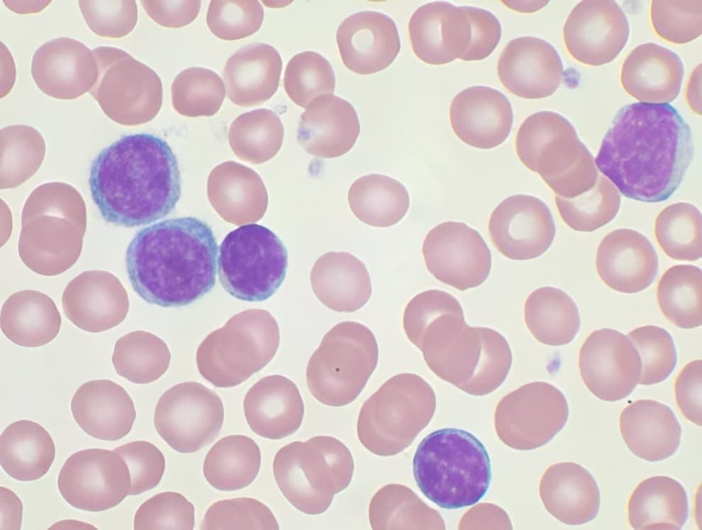 Ascentage Pharma Advances Bcl-2 Inhibitor for CLL/SLL