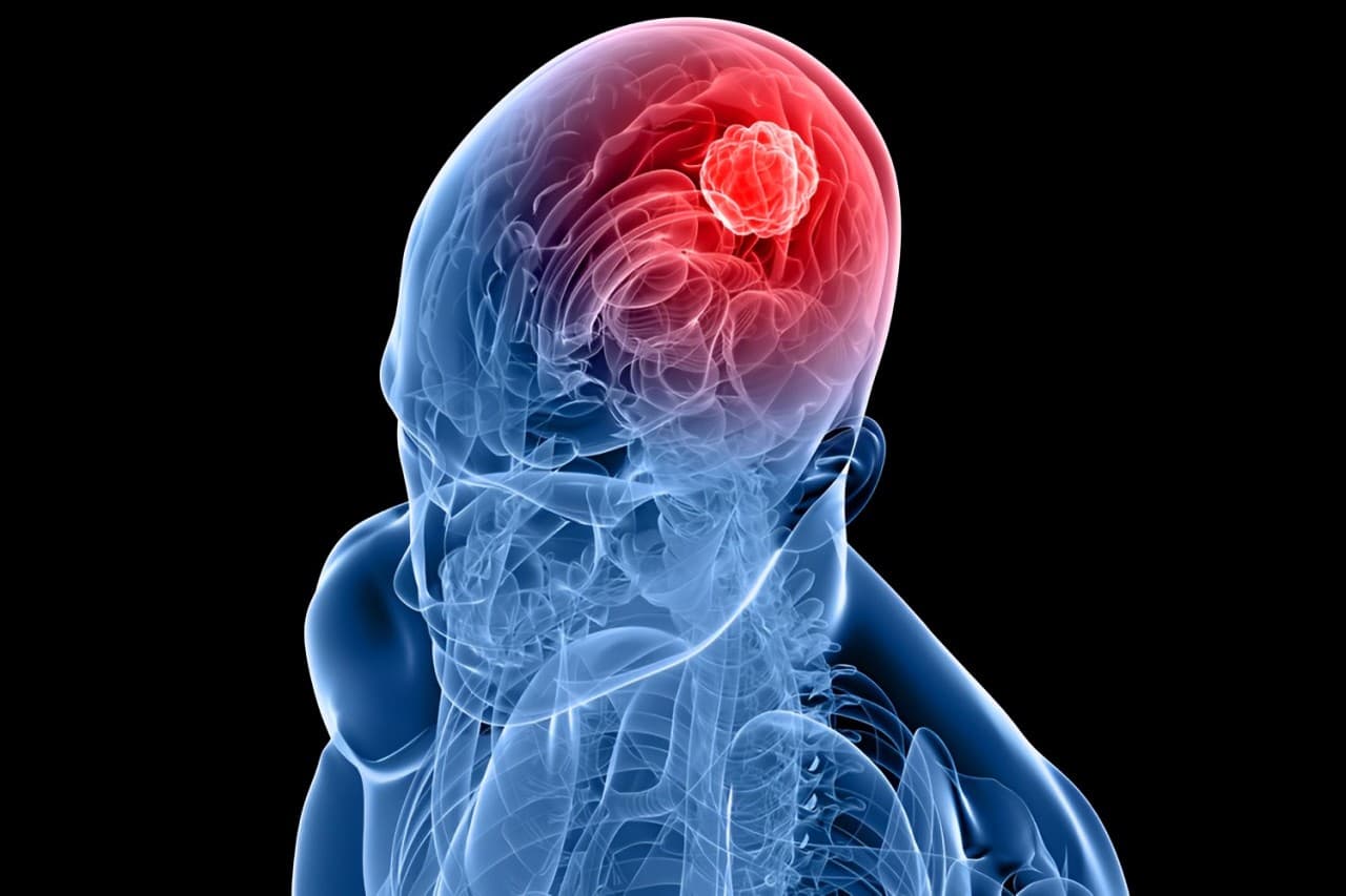 Shuttle Pharma Advances Phase 2 Trial For Promising Glioblastoma Treatment With Ropidoxuridine