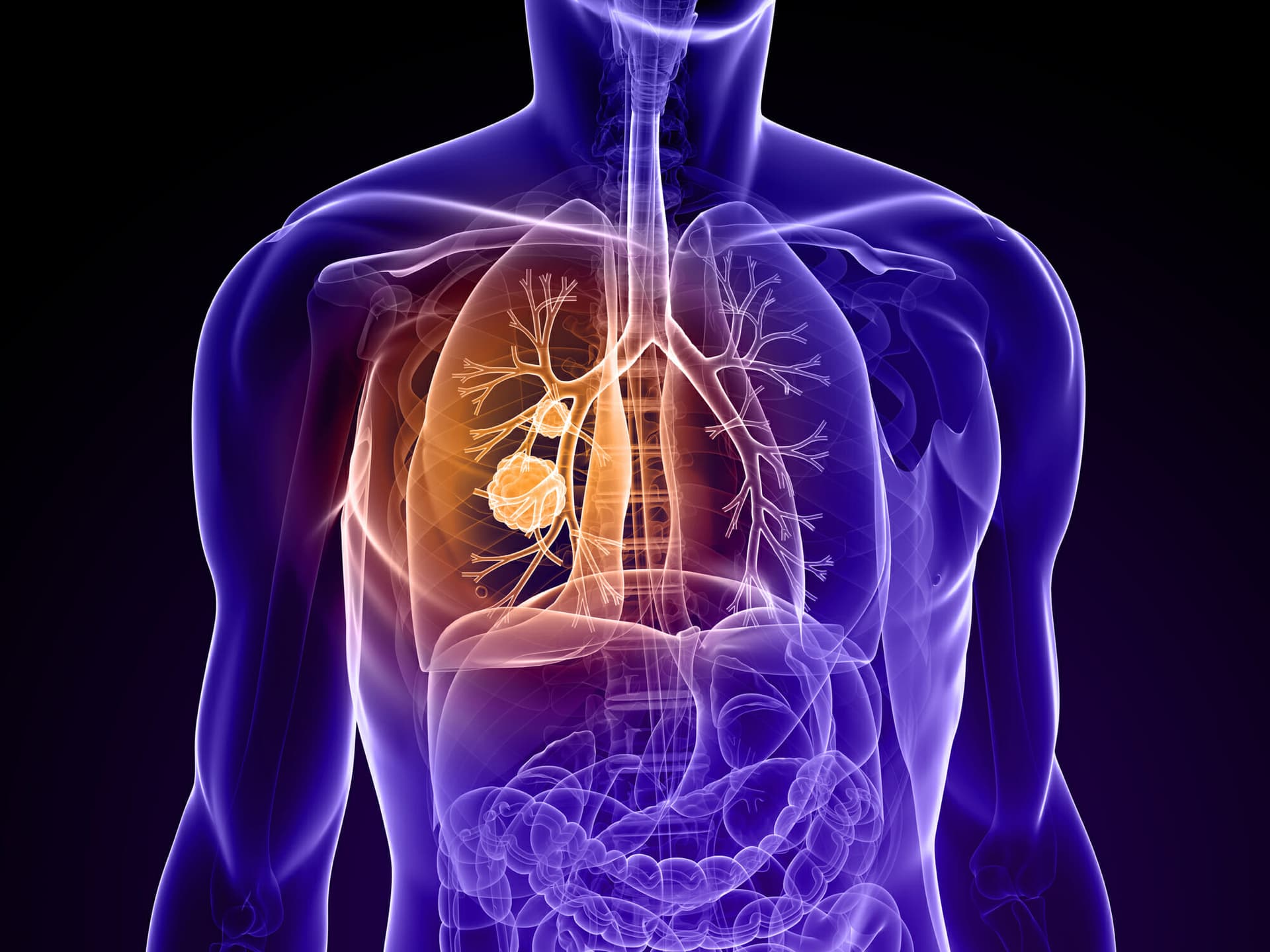 First Patient Dosed in IDeate-Lung02 Trial for Relapsed SCLC