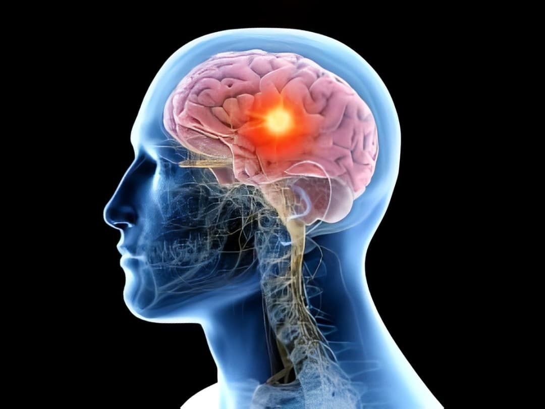 Shuttle Pharma Advances Phase 2 Trial Of Ropidoxuridine For Glioblastoma