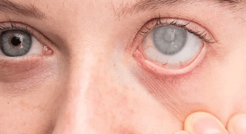 Artelo Biosciences Achieves First Patient Dosing in Phase 2 DREAM Study for Glaucoma