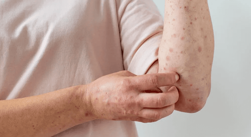 Evotec Signs AI-Driven Drug Discovery Deal with Odyssey Therapeutics for Autoimmune Pipeline