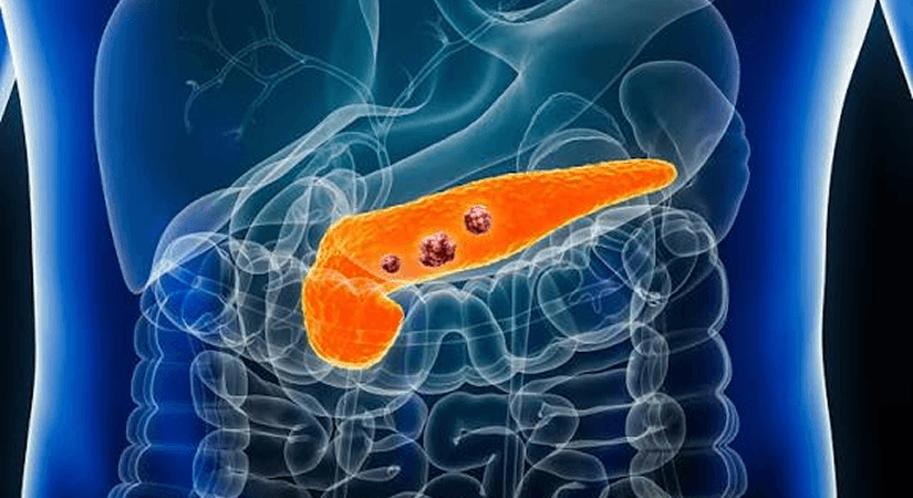 FDA Approves First Targeted Therapy for Metastatic Pancreatic Cancer